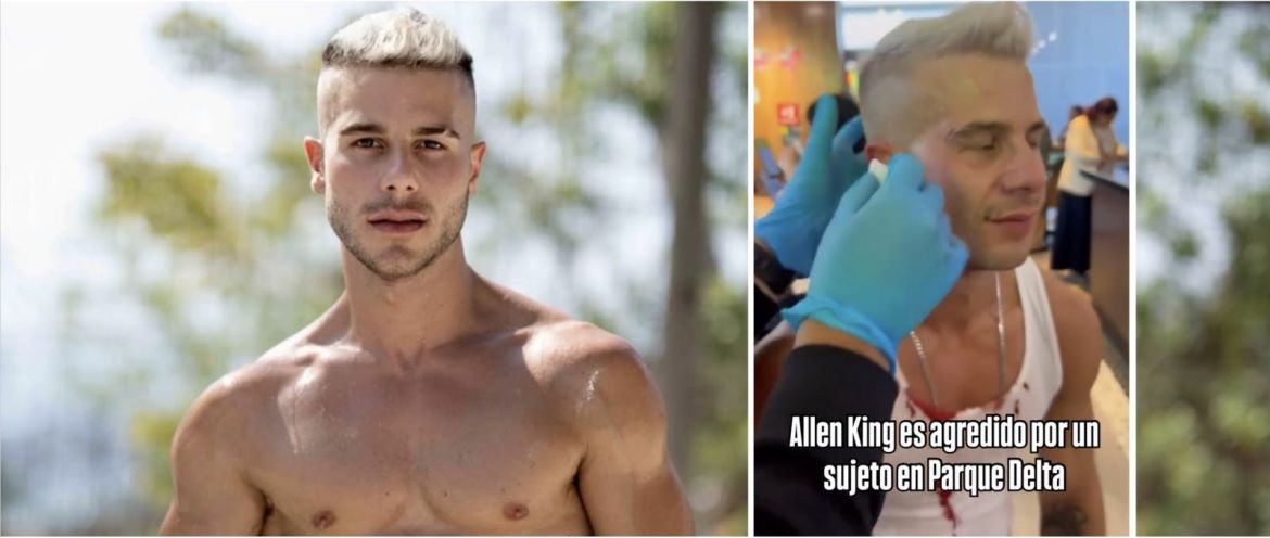 Agression dans un café ! Allen King en sang après qu’un inconnu lui a violemment jeté une tasse au visage